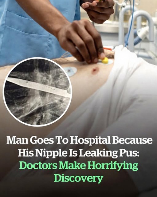 Man goes to hospital because his nipple is leaking pus: Doctors make horrifying discovery