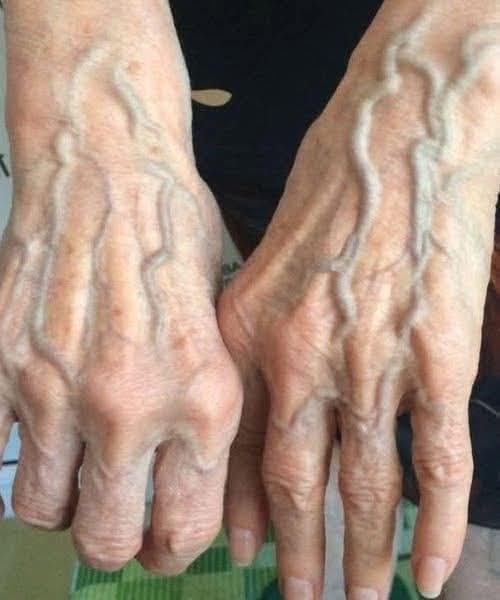 If your veins are visible in your hand, it is a signal of…