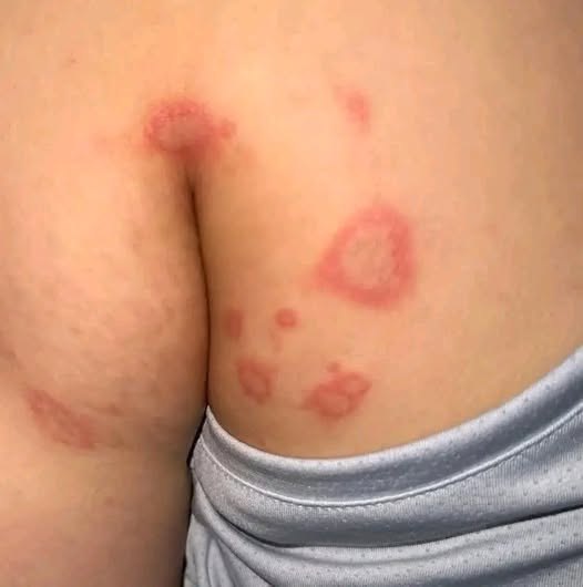 HT9. Why Bumps Appear in the Gen!tal Area