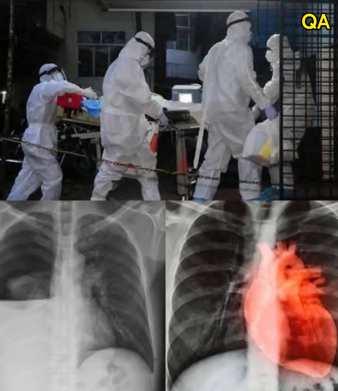 Understanding Rare Myocarditis Cases After mRNA COVID-19 Vaccination: New Insights from Science