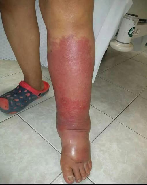 Why Do Feet Swell? Complete Guide to Common Causes and When to Seek Help